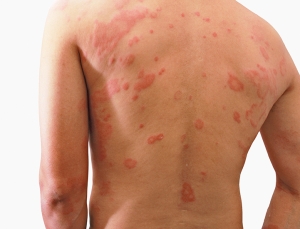 Dermatitis - Our advanced product Recovery, abundant in S²RM® molecules is the best choice for outbreaks of dermatitis. 