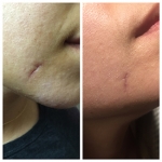 Before and 3 Days After Photo of Dog Bite Scar Healing with NeoGenesis Recovery