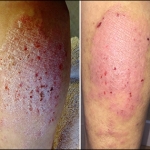 MF - Dermatitis Before and After Pics