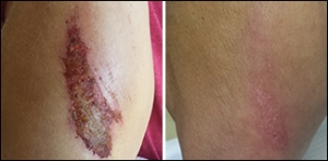 Review - NeoGenesis Recovery for wound care and scarring