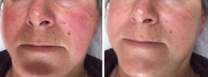 rosacea-jw-before-after