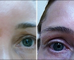 Review - Customer review of NeoGenesis skincare products for fraxel laser scar healing