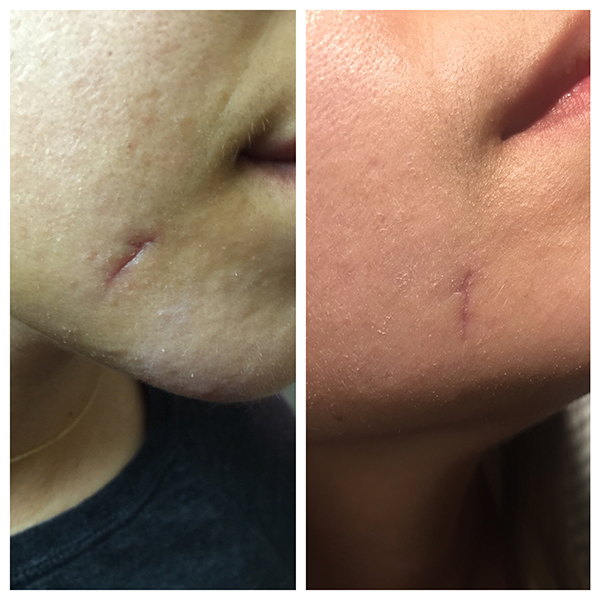 Photo on right taken 3 days after using NeoGenesis Recovery