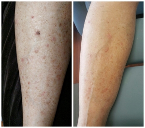 Chemo Rash - Recovery Serum Testimonial