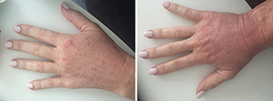 Fraxel Laser Product Comparison