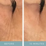 Before + After - Ageing Skin - Crows Feet