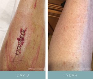 Before + After - Wound Care - Tumor