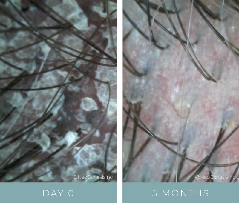 Before + After - Psoriasis