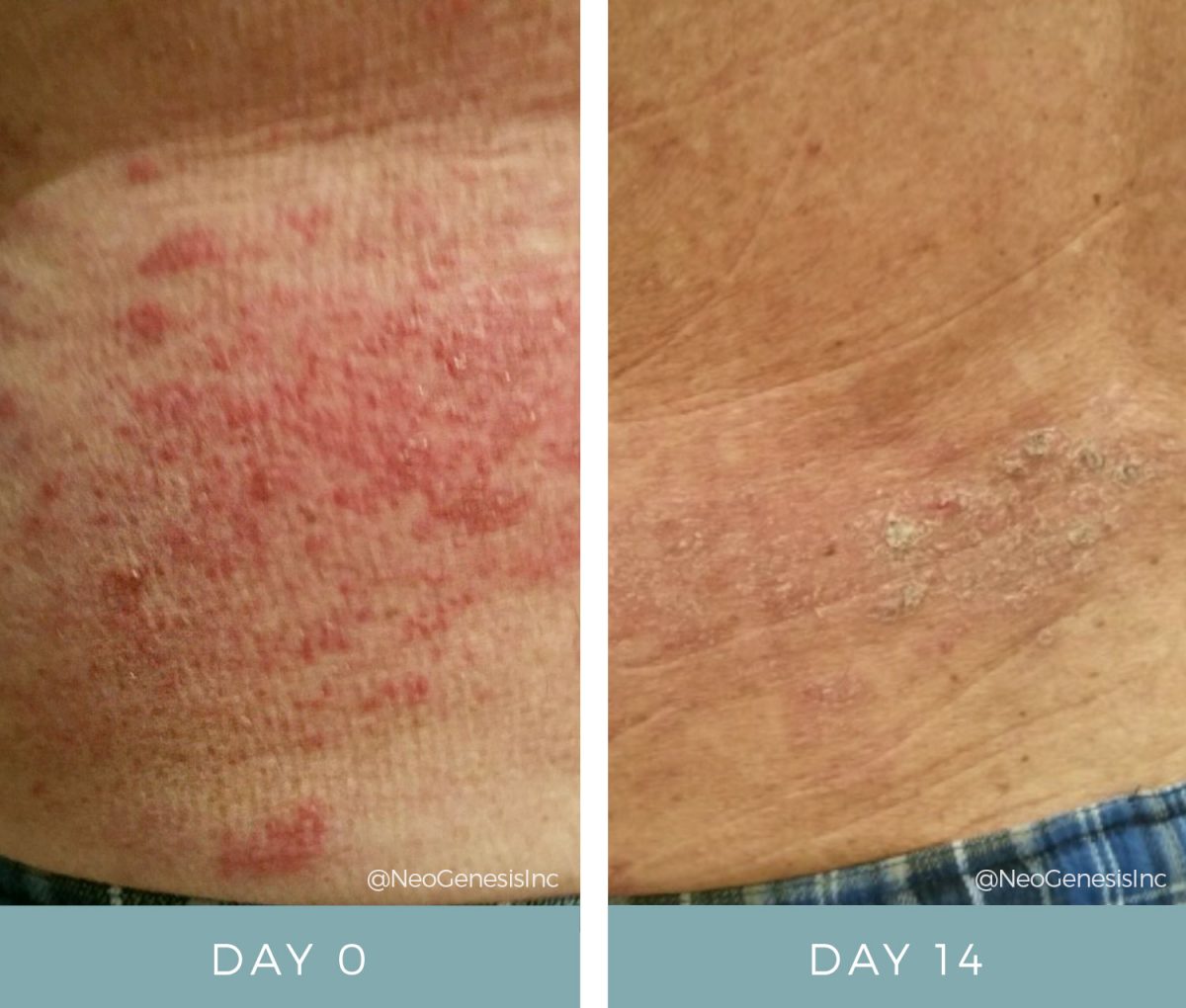 Review Shingles Before + After NeoGenesis Recovery Serum for Shingles