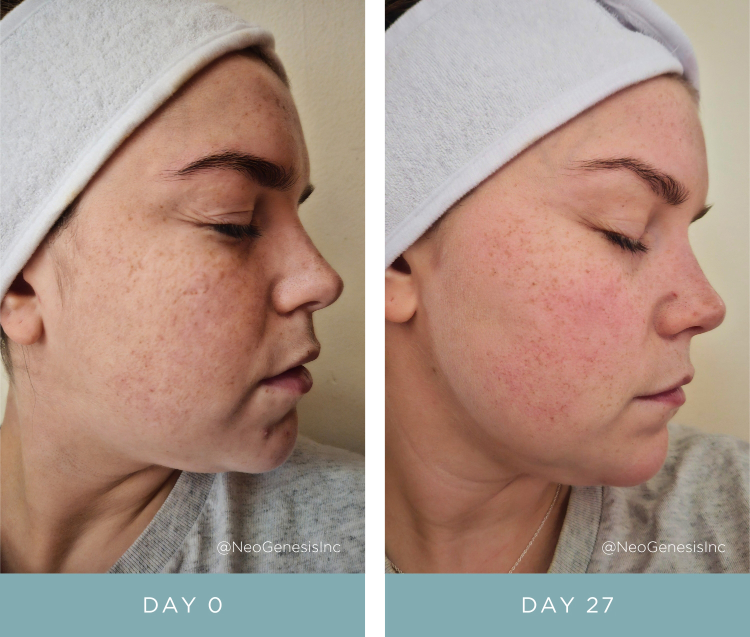 Before + After - NeoGenesis Vibrant C Serum for Hyperpigmentation