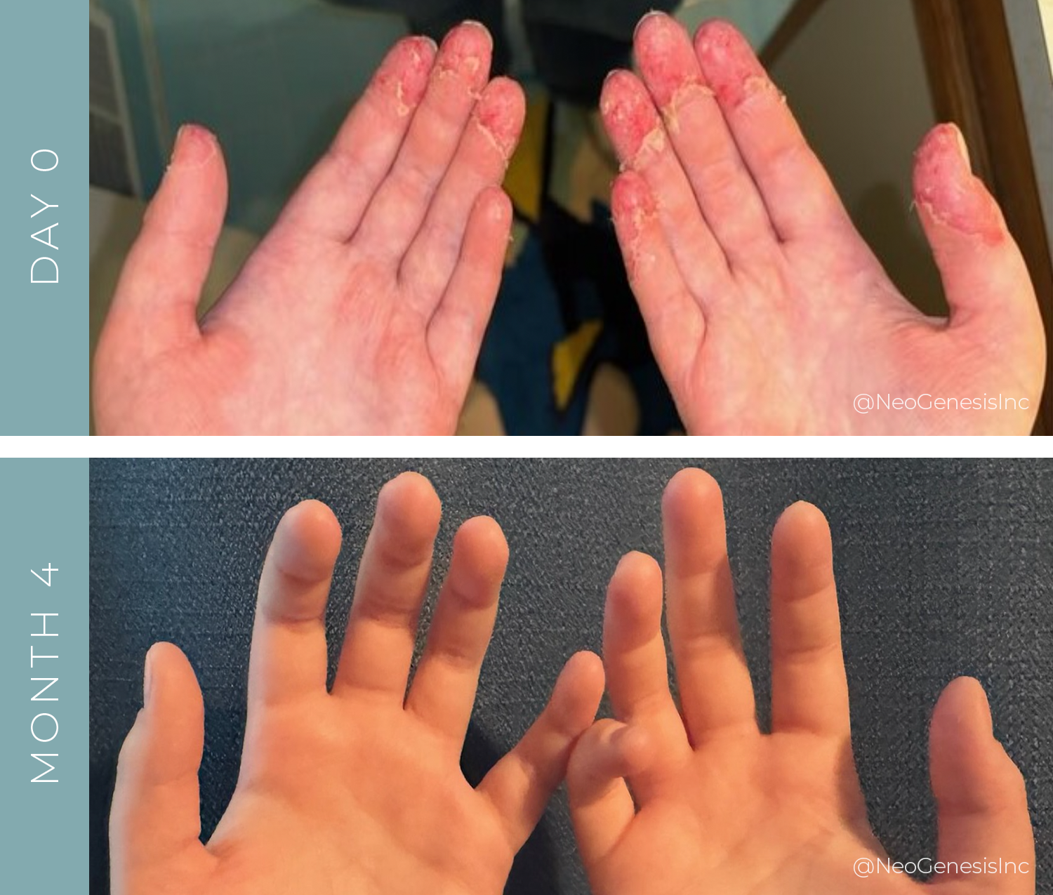 Before + After – Contact Dermatitis Before + After - Contact Dermatitis